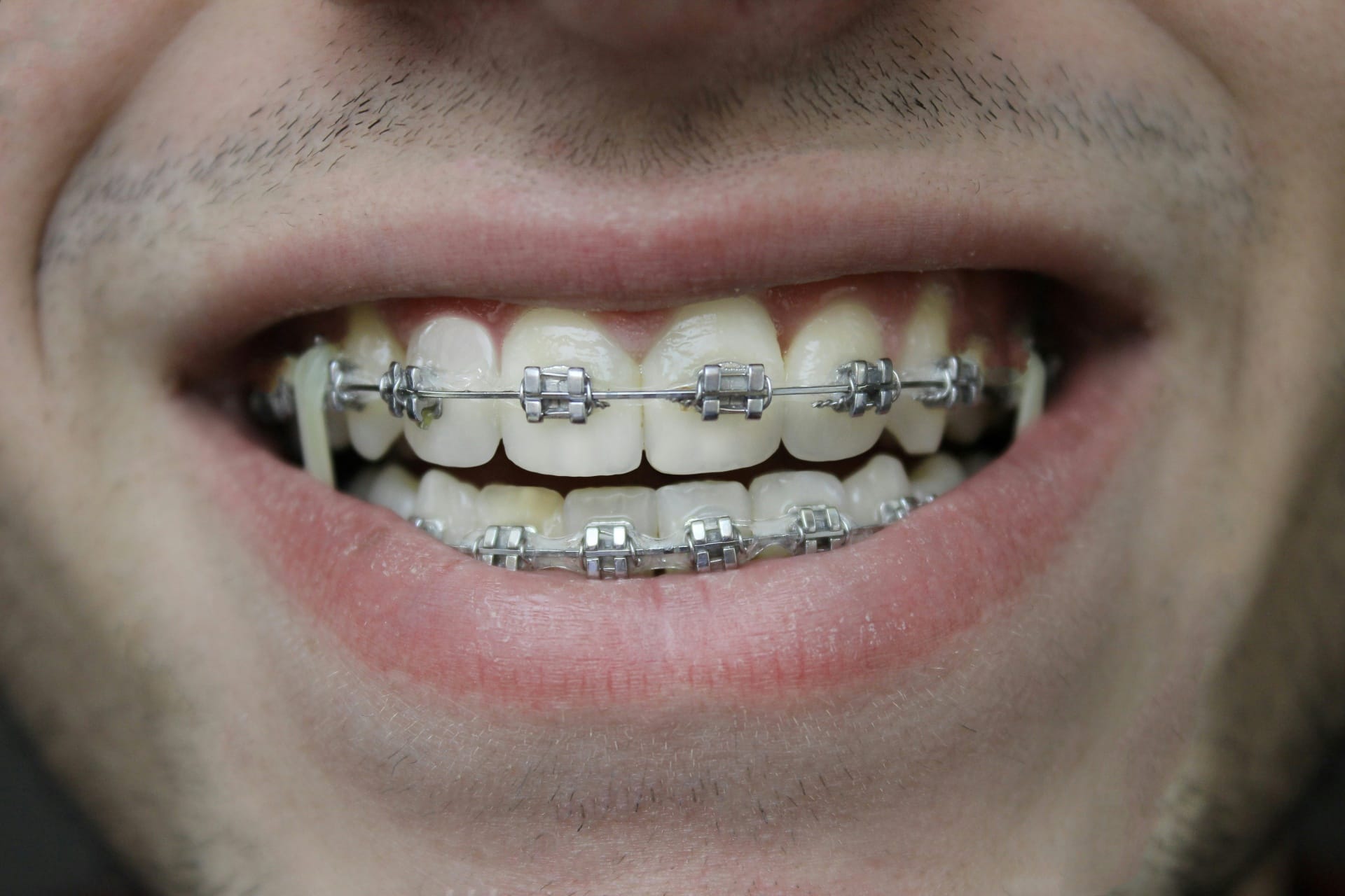 Not all braces are created equal—some work faster, some are more discreet, and some offer more comfort. 