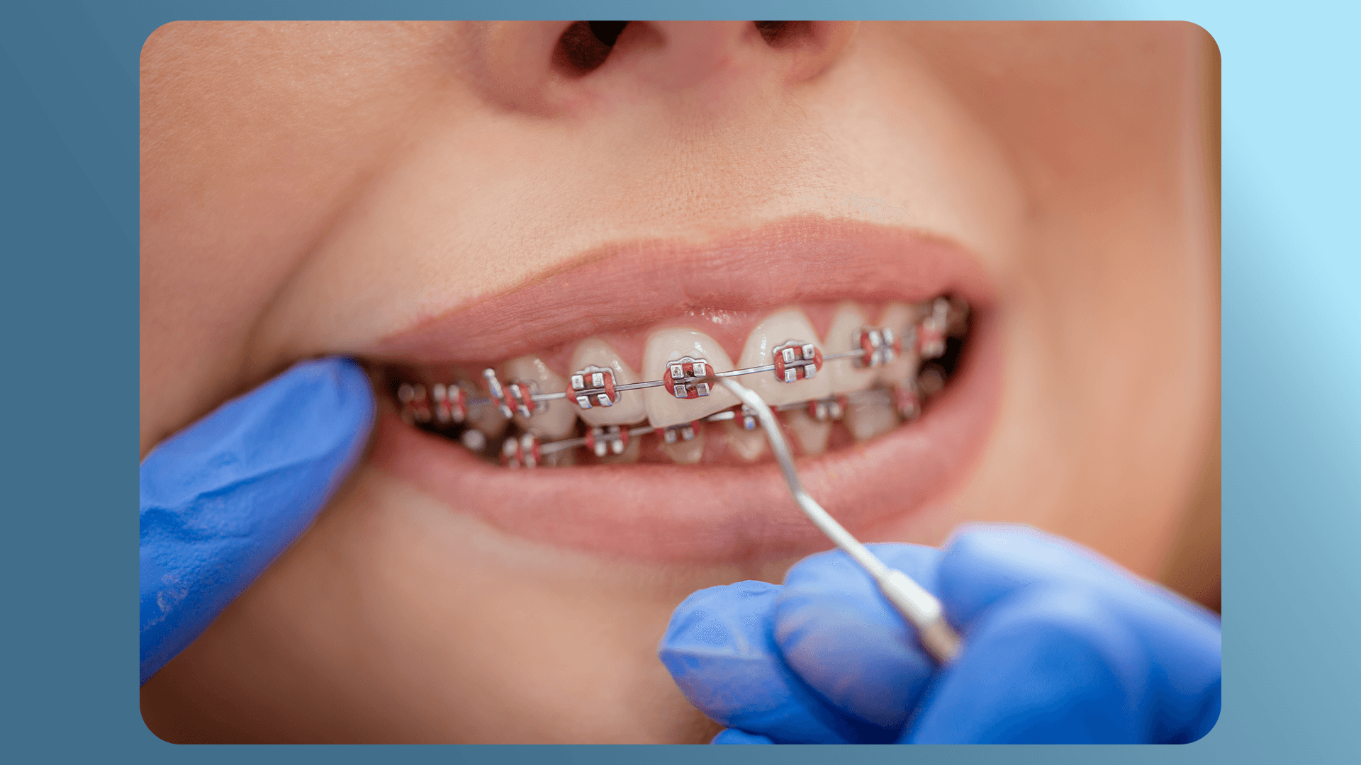 Here is what you would expect when it comes to braces insurance coverage in Washington