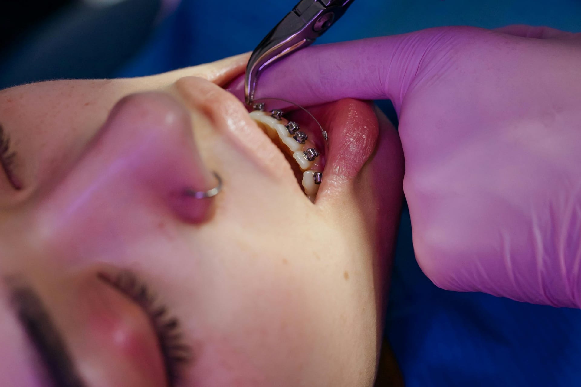 Here are the things you need to know before getting dental braces for adults